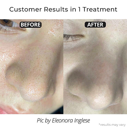 Unclog Your Pores & Remove Unwanted Blackheads In Minutes 