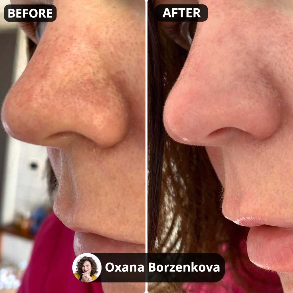 Unclog Your Pores & Remove Unwanted Blackheads In Minutes 