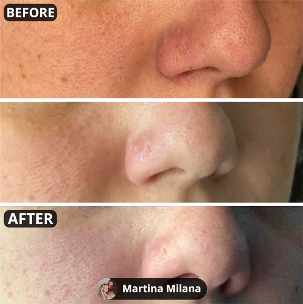 Unclog Your Pores & Remove Unwanted Blackheads In Minutes 