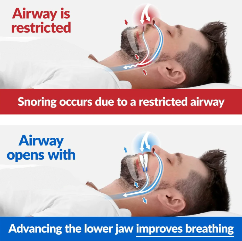 Anti Snoring Mouthpiece