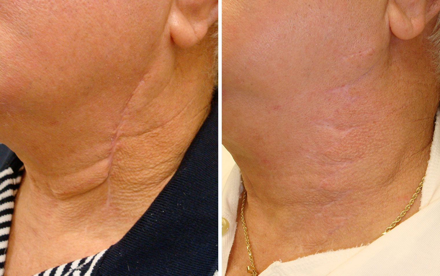 Scar Therapy - VIDA Wellness and Beauty