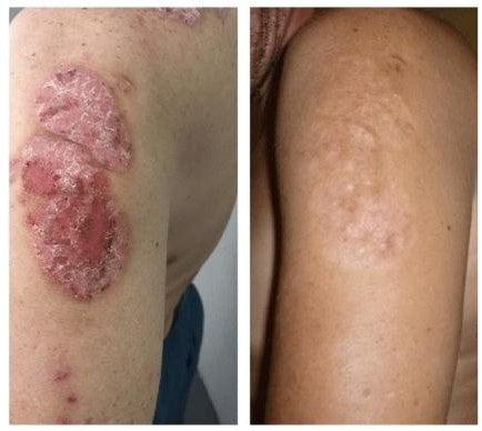 SKINMEDIX™PSORIASIS CREAM