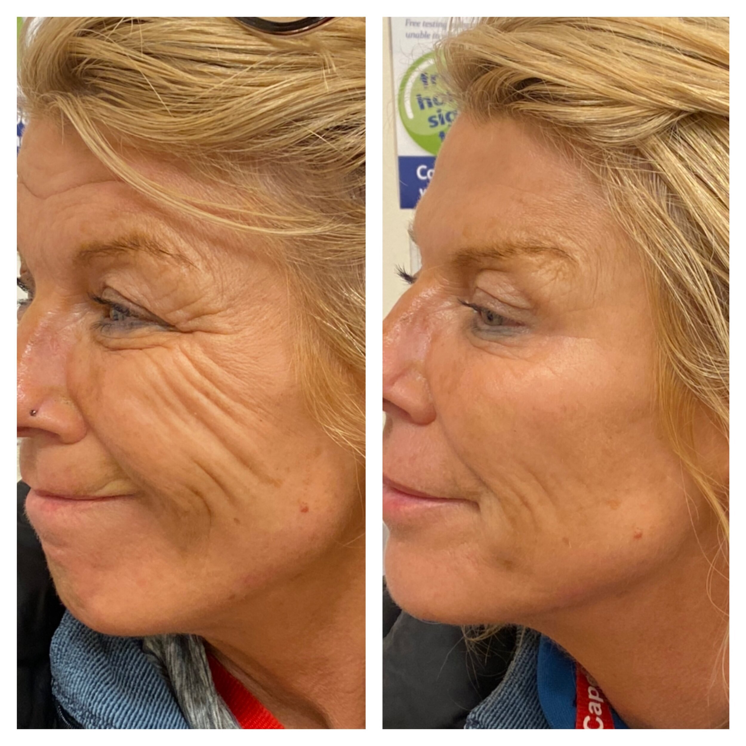 Tee's Anti-wrinkle treatment experience — Escape Aesthetics