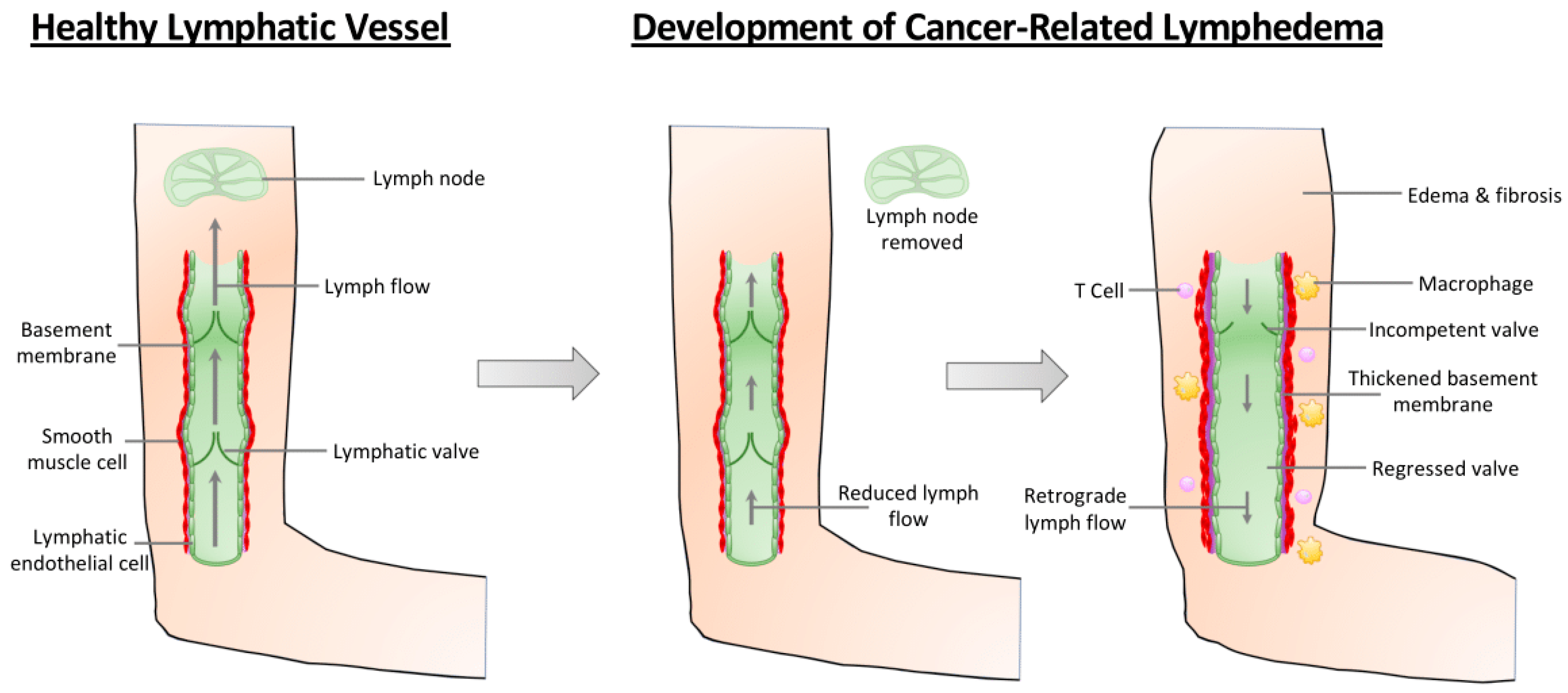 Καρκίνος |  Δωρεάν πλήρες κείμενο |  Λεμφικές βαλβίδες και λεμφική ροή στο λεμφοίδημα που σχετίζεται με τον καρκίνο