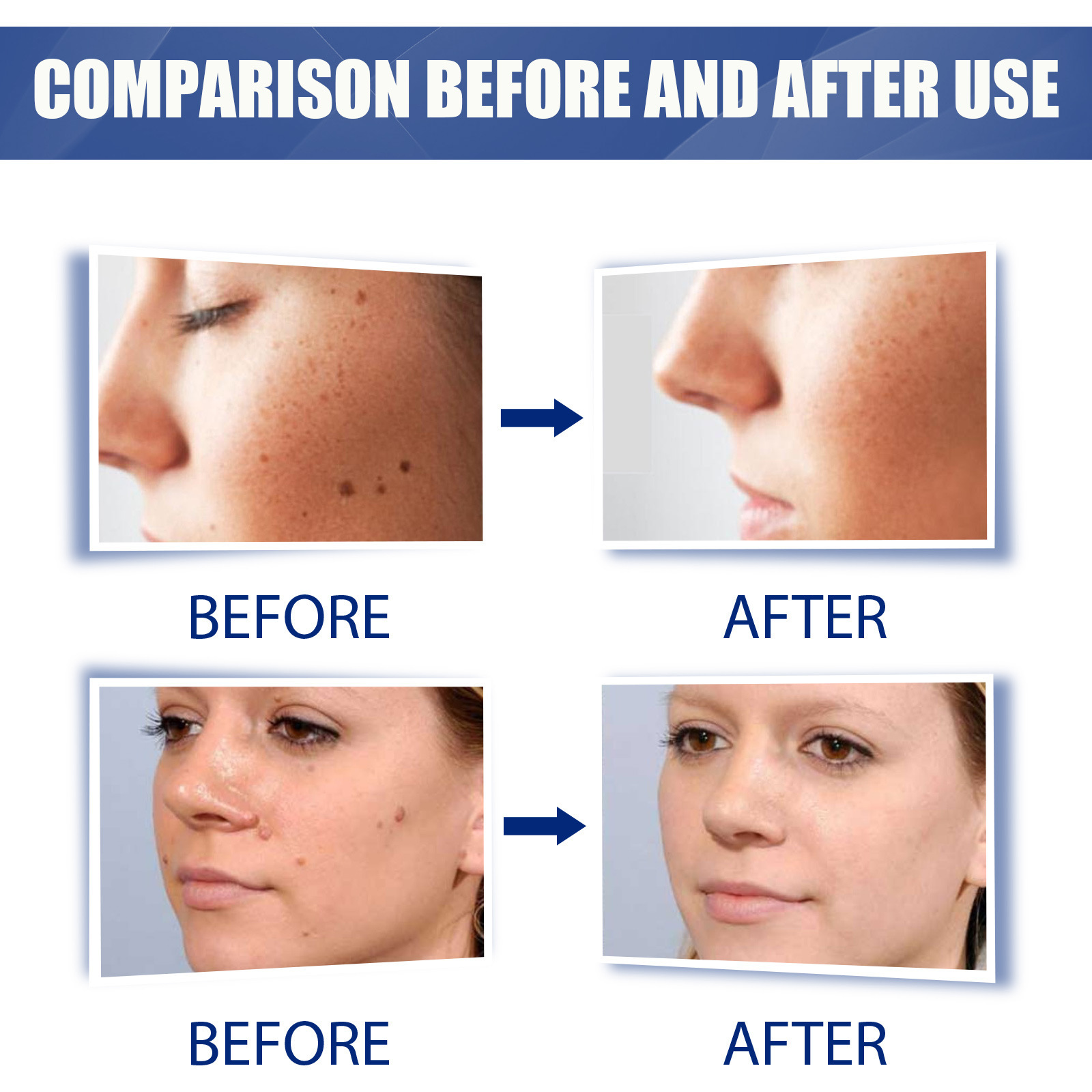 （🔥LAST DAY SALE-30% OFF)Wart Removal Ointment