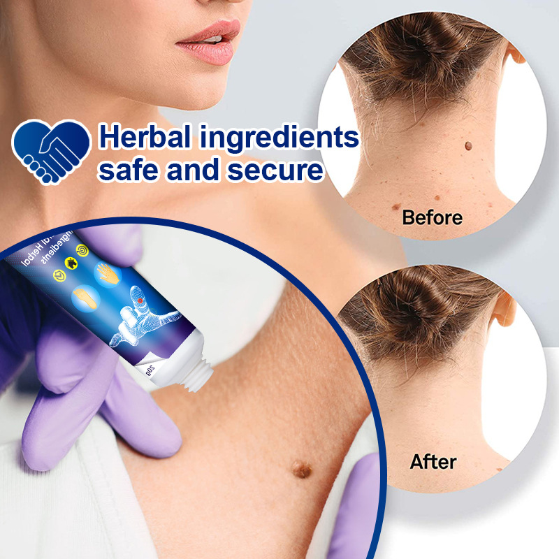 （🔥LAST DAY SALE-30% OFF)Wart Removal Ointment