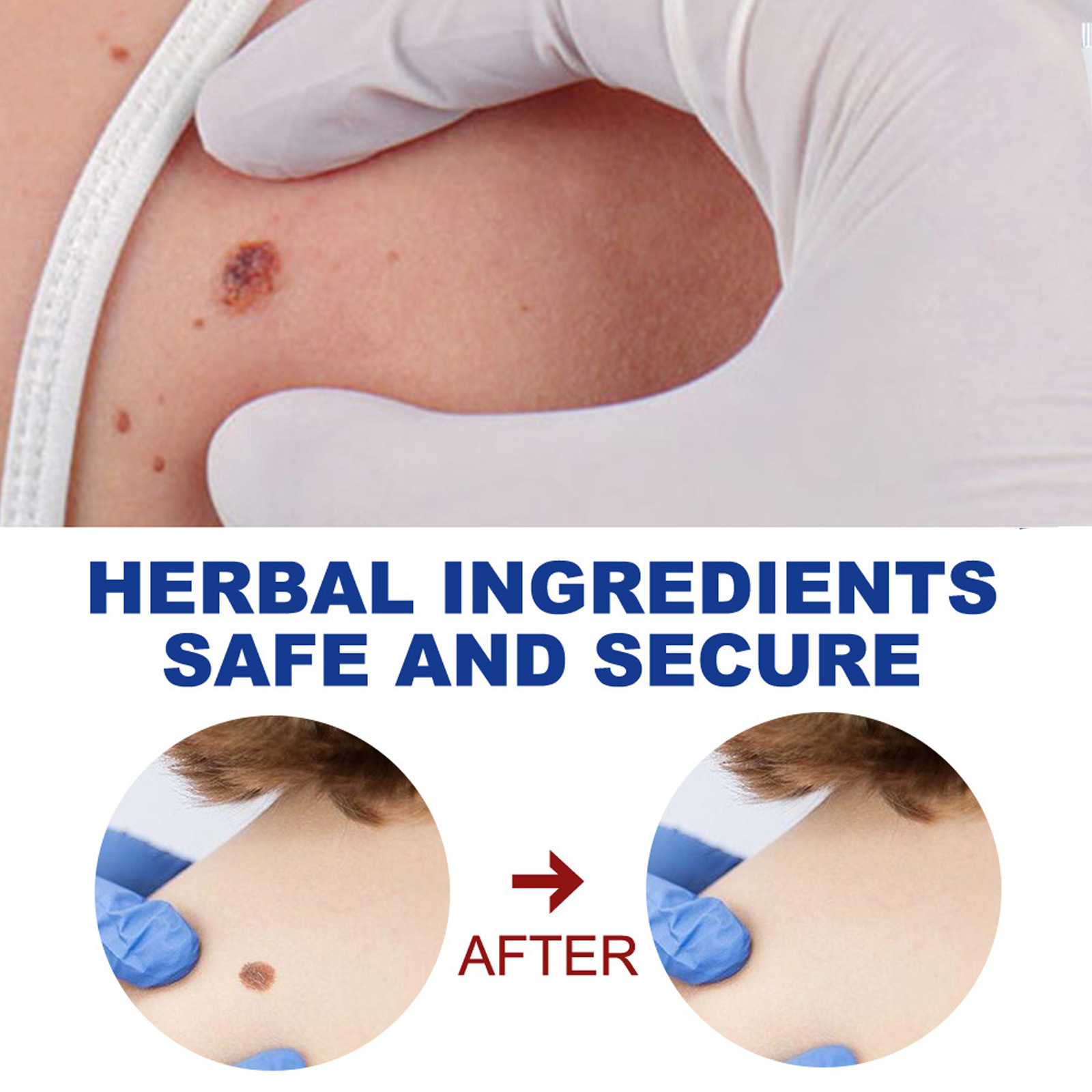 （🔥LAST DAY SALE-30% OFF)Wart Removal Ointment