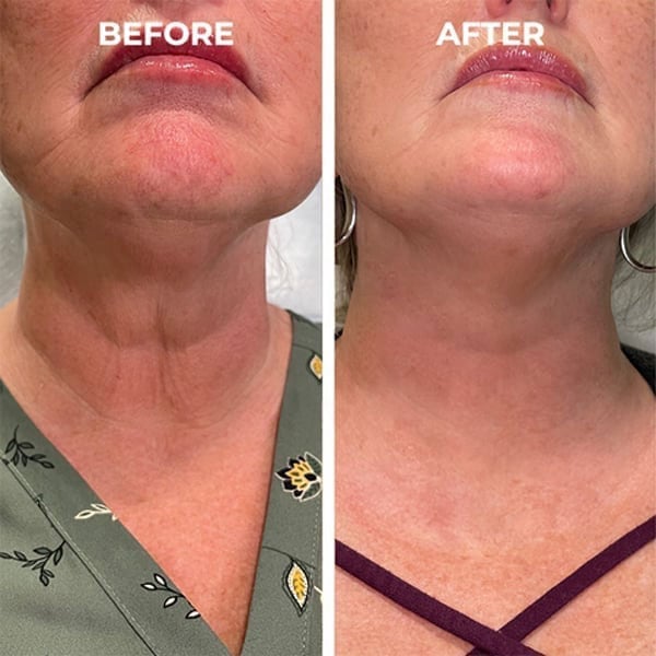 Last Day Promotion 30% OFF - 🔥Botox Face Serum