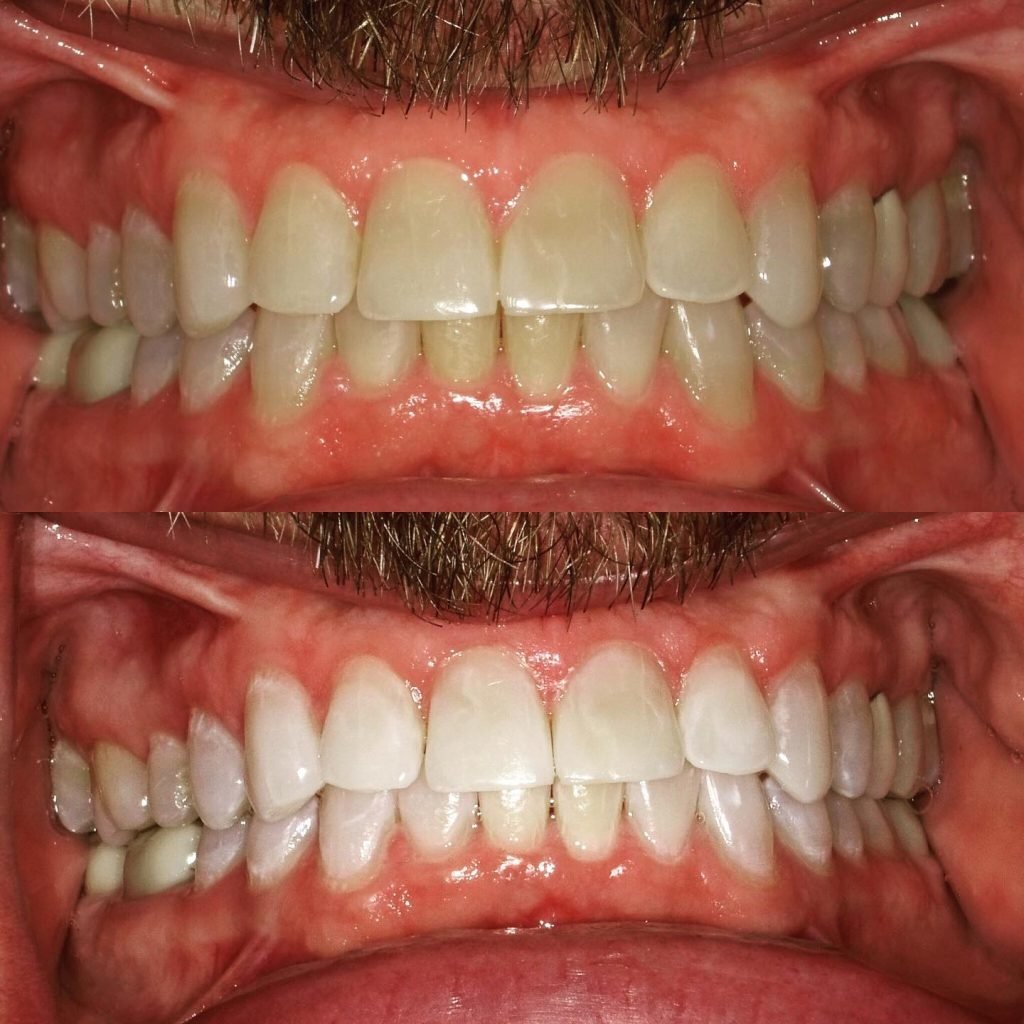 Zoom Whitening San Jose CA | In Office Teeth Whitening