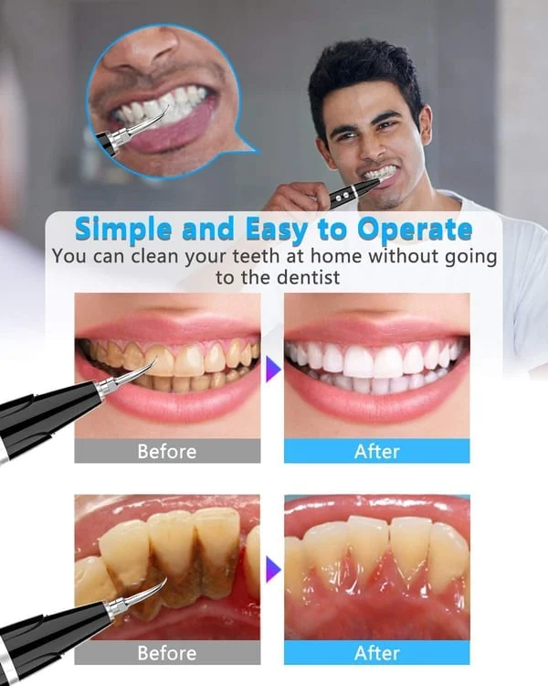 (🔥Spring Promotion 48% OFF) Electric tooth cleaning instrument -Teeth Cleaner-Festivesl