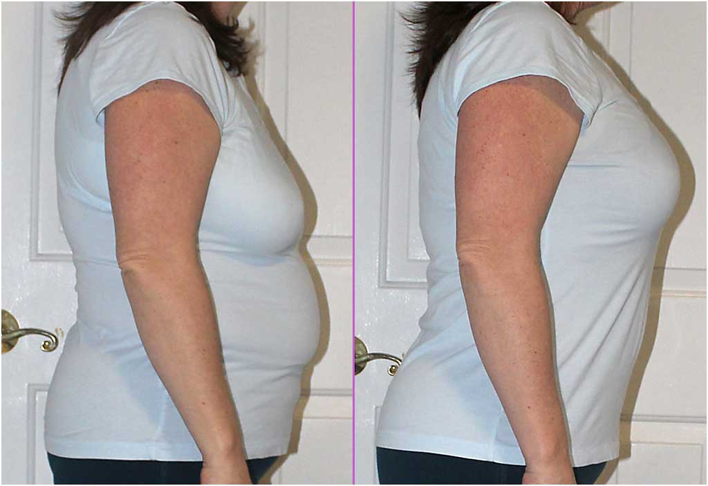 Μεταμορφώσεις της πραγματικής ζωής στο 'Back Fat Free Bra' - Πριν και Μετά τις Εικόνες - Shapeez
