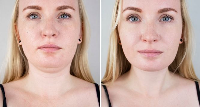All About Non-Invasive Double Chin Liposuction
