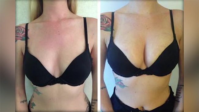 Peitos de f&eacute;rias: divertido ou tolo |  O Canal de Cirurgia Pl&aacute;stica