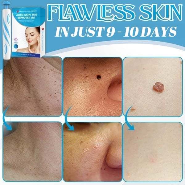 [Copy]Auto Micro Skin Tag Remover