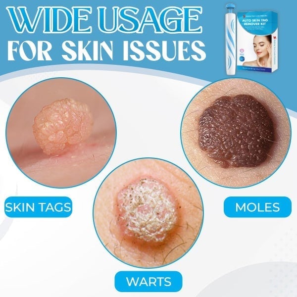 [Copy]Auto Micro Skin Tag Remover