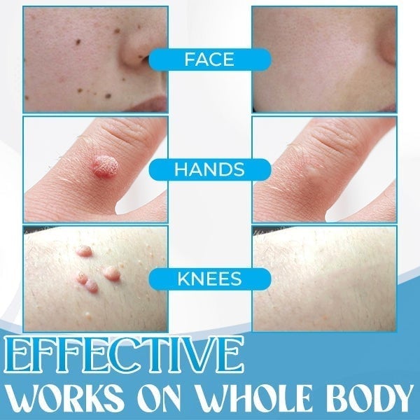 [Copy]Auto Micro Skin Tag Remover