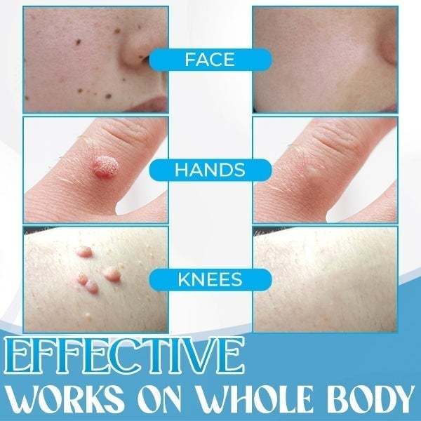 [Copy]Auto Micro Skin Tag Remover