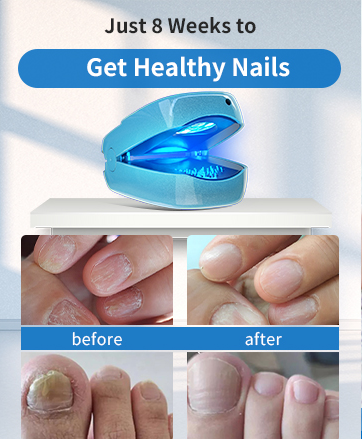 KTS Toenail Fungus Laser Device for Onychomycosis-KTS HEALTHCARE