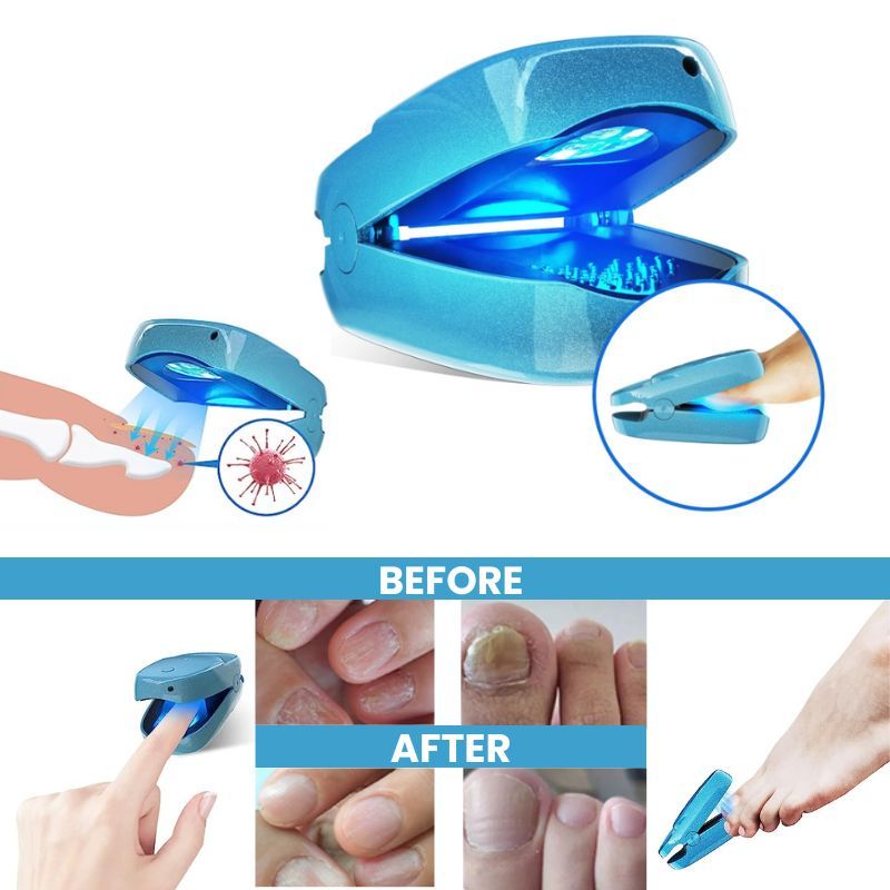 KTS Toenail Fungus Laser Device for Onychomycosis-KTS HEALTHCARE