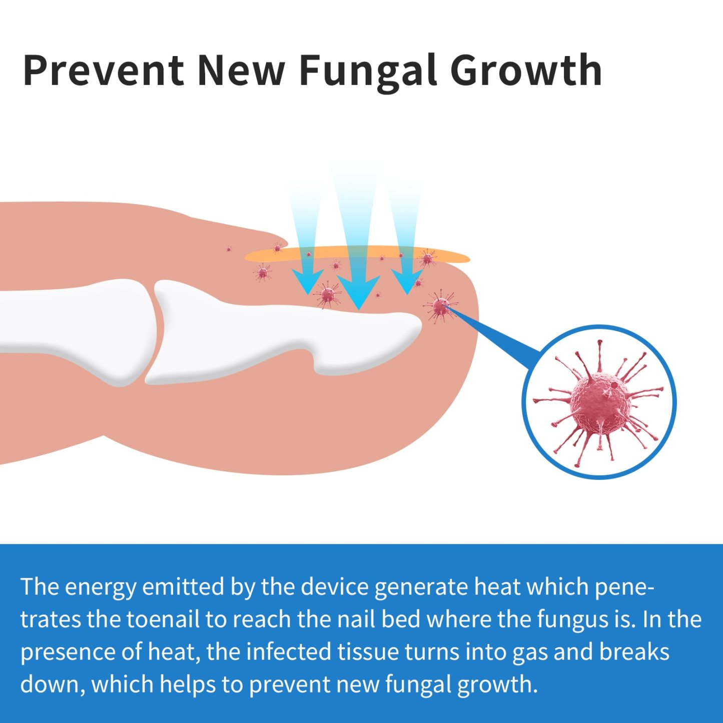 KTS Toenail Fungus Laser Device for Onychomycosis-KTS HEALTHCARE