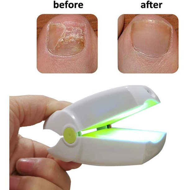 KTS Antifungal Laser Device for Onychomycosis White-KTS HEALTHCARE