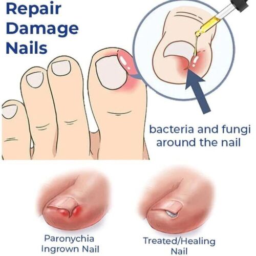 German Toenailcare Removal Paronychia Oil