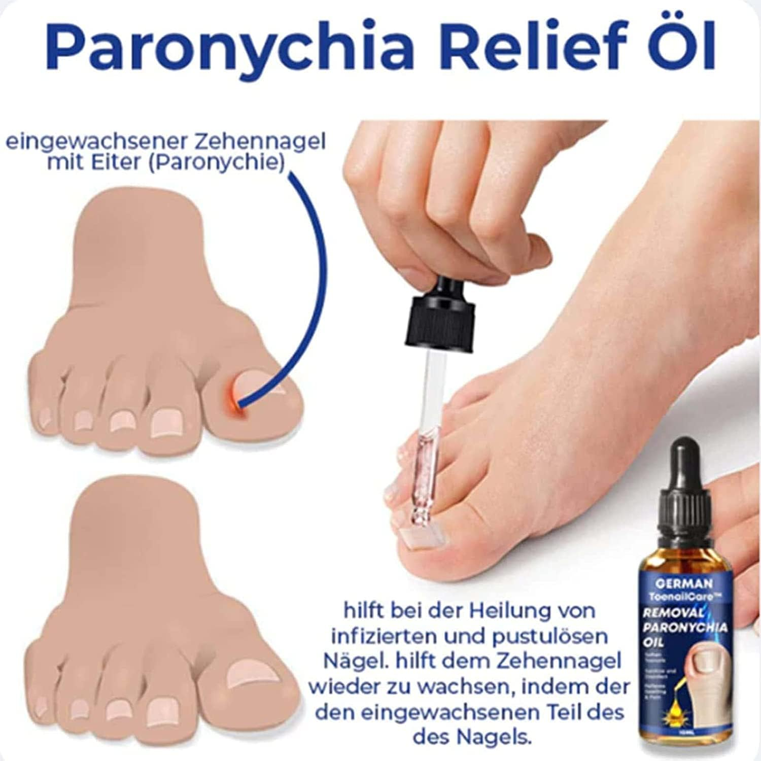 German Toenailcare Removal Paronychia Oil