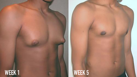 1 Adolescent with Gynecomastia