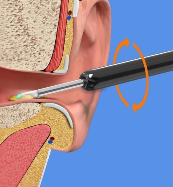 🎁LAST DAY PROMOTION 49%OFF🎁 WI -FI VISIBLE WAX ELIMINATION SPOON-USB 1080P HD LOAD OTOSCOPE