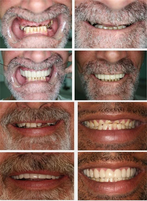 （Duty Free）Last day discount-(50%Off)- Adjustable snap-on dentures