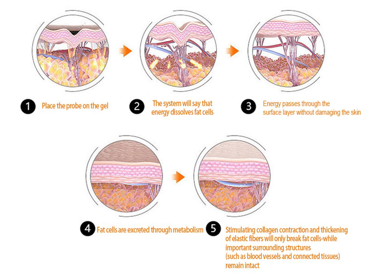 body slimming machine cellulite removal machine