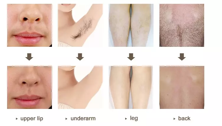 Multifunctional IPL Opt Nd Yag Laser Permanent Hair And Tattoo Removal Picosecond Laser Acne Removal Machine