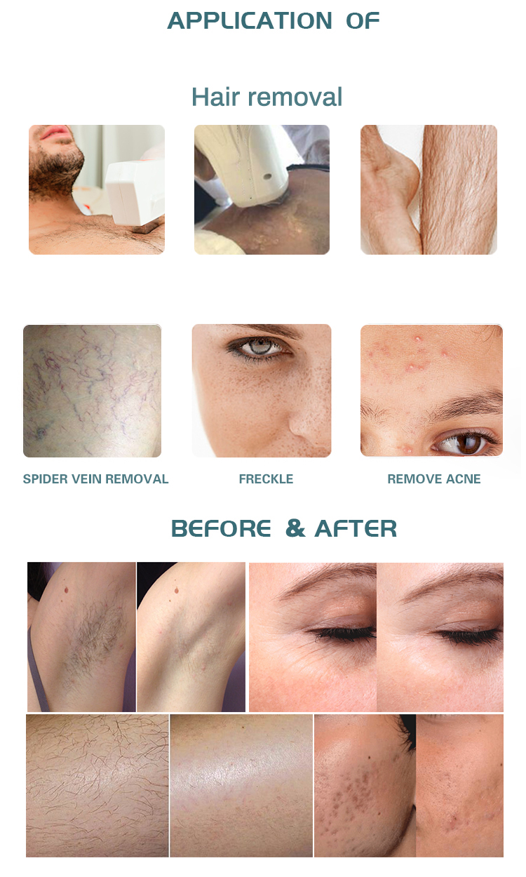 2022new 3000W Dpl Hair Removal Aopt Nir Dpl Hair Removal Machine Opt Skin Tightening Machine Opt Laser Hair Removal