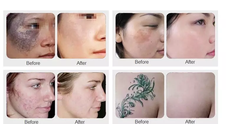 Multifunctional IPL Opt Nd Yag Laser Permanent Hair And Tattoo Removal Picosecond Laser Acne Removal Machine