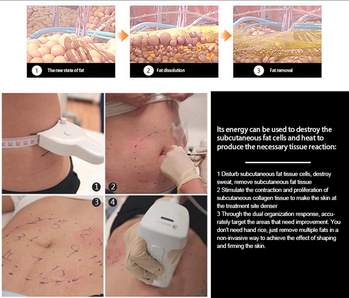 body slimming machine cellulite removal machine