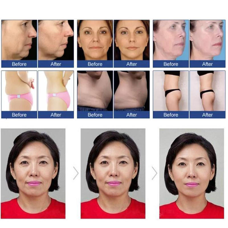 2 in 1 Portable Vmax Radar Line Carving Non Surgical Wrinkle Anti-Wrinkle Removal Face Lift Skin Tightening Rejuvenation Ultrasound Machine