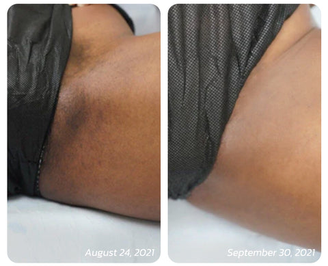 acanthosis nigricans inner thighs