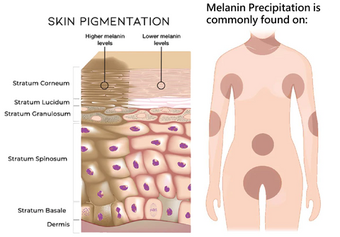 Glow™ EELHOE-Acanthosis Nigricans Therapy Cream