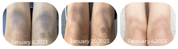 Glow™ EELHOE-Acanthosis Nigricans Therapy Cream