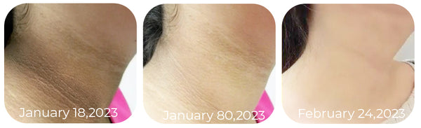 Glow™ EELHOE-Acanthosis Nigricans Therapy Cream