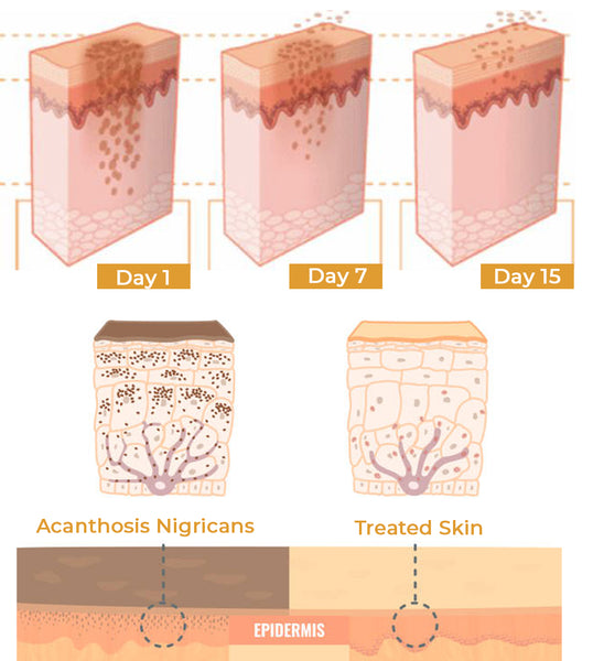 Glow™ EELHOE-Acanthosis Nigricans Therapy Cream