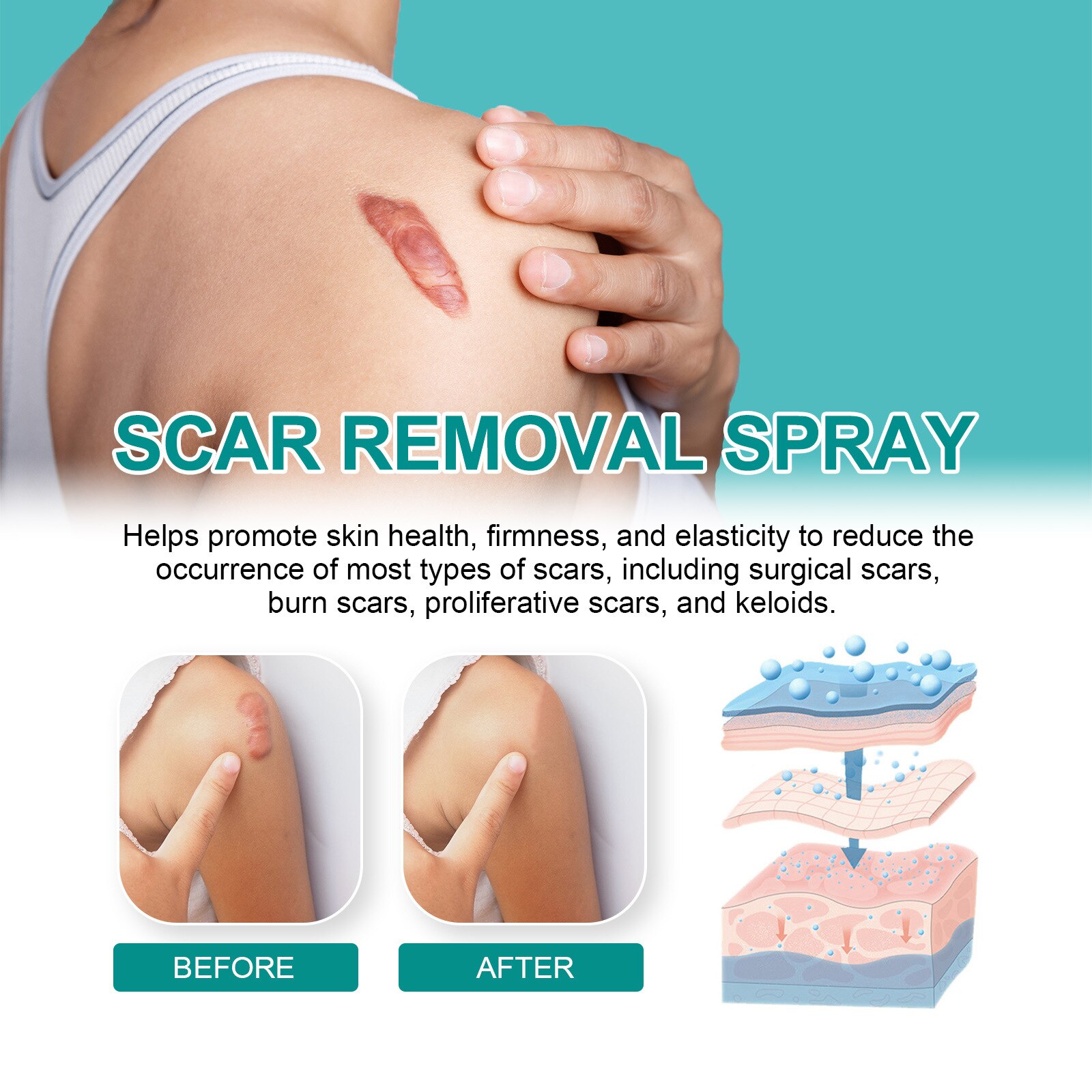🔥LAST DAY 70% OFF❤️SouthMoon Advanced Scar Spray For Acne Scars, Surgical Scars and Stretch Marks