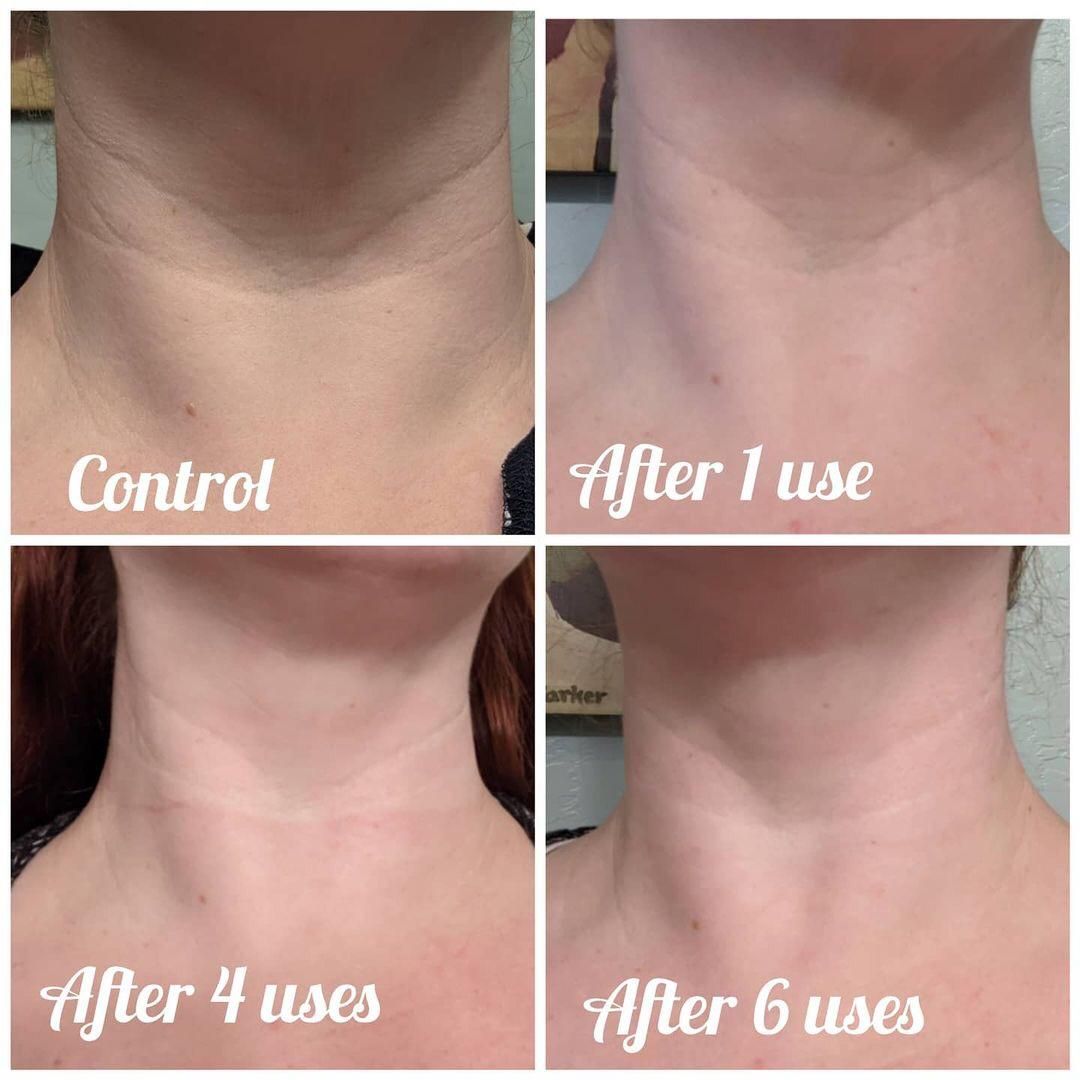neck wrinkles treatment - Online Discount Shop for Electronics, Apparel, Toys, Books, Games, Computers, Shoes, Jewelry, Watches, Baby Products, Sports & Outdoors, Office Products, Bed & Bath, Furniture, Tools, Hardware, Automotive Parts,