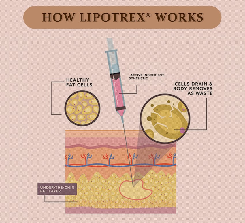 Lioptrx INTENES Lipolytic Solution (2)